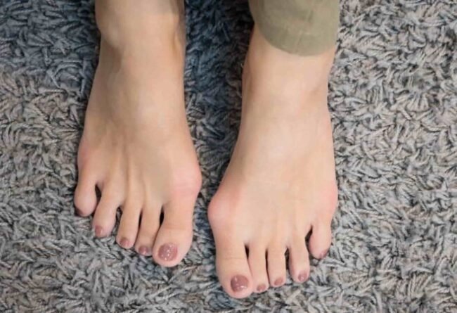 Tratamento de hálux valgo (joanete) em podologia Vila Velha ES - Instituto Rita Dallorto