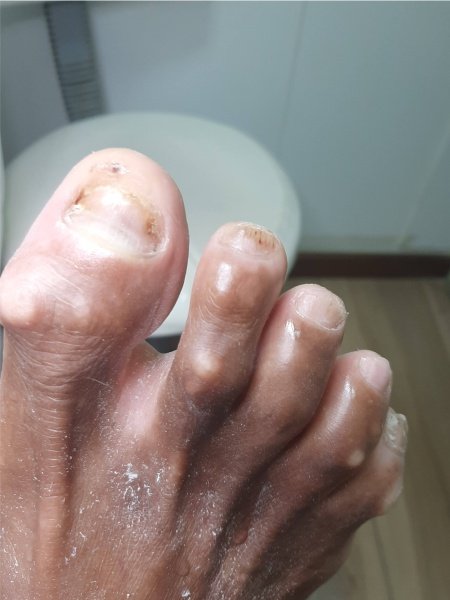 Tratamento podológico seguro para diabéticos em Vila Velha ES - Instituto Rita Dallorto