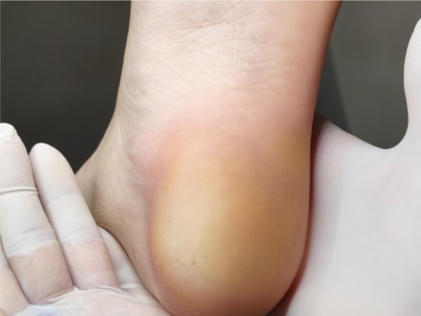 Resultado de pés saudáveis e hidratados após limpeza profissional no Instituto Rita Dallorto Vila Velha ES