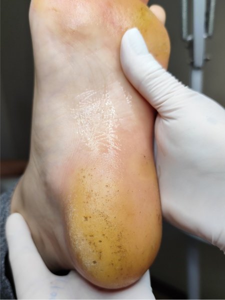 Pés sujos com fungos