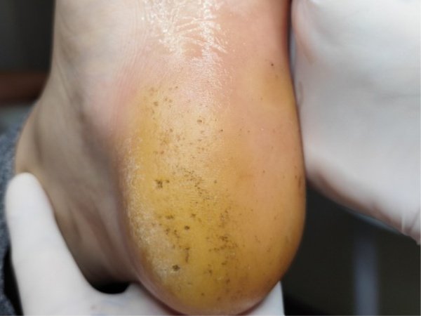 Pés necessitando de limpeza profunda