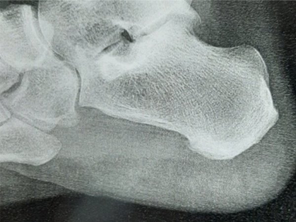 Raio-X mostrando esporão de calcâneo e diagnóstico profissional em Vila Velha ES