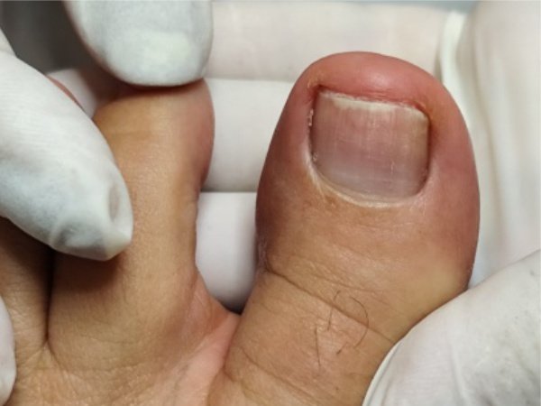 Tratamento profissional de micose de unha com desbaste e aplicação de antifúngicos no Instituto Rita Dallorto Vila Velha ES