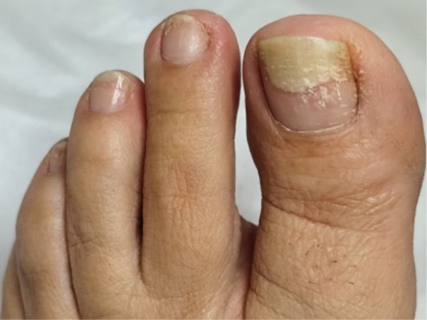 Exemplo de micose de unha (onicomicose) e tratamento especializado em Vila Velha ES - Instituto Rita Dallorto