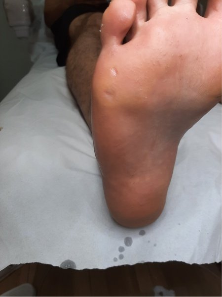 Pés macios e saudáveis após tratamento