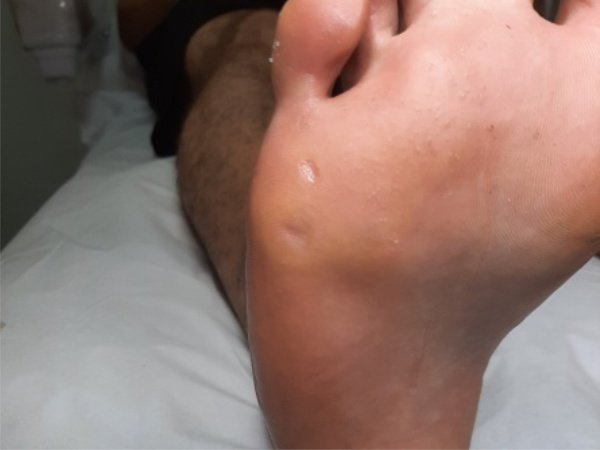 Tratamento profissional de verruga plantar com técnicas especializadas no Instituto Rita Dallorto Vila Velha ES