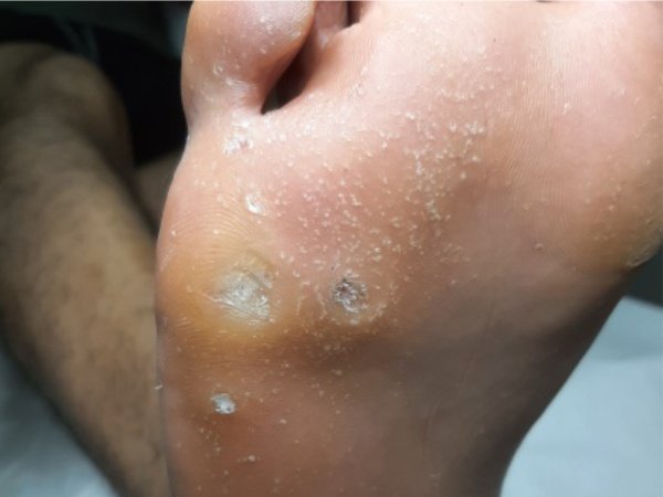 Verruga plantar (olho de peixe) nos pés - tratamento especializado em podologia Vila Velha ES