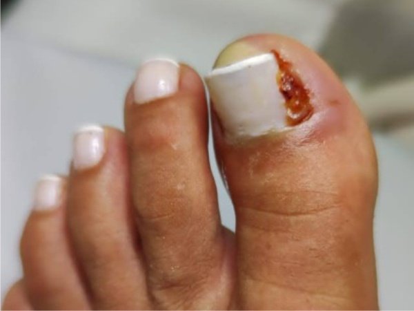 Tratamento profissional de unha encravada em podologia Vila Velha ES - Instituto Rita Dallorto