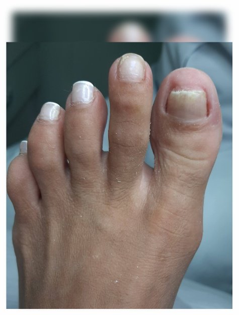 Unha tratada após procedimento podológico