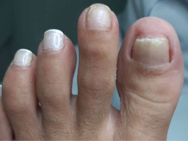 Podóloga Rita Dallorto realizando tratamento de unha encravada em Vila Velha ES com equipamentos modernos