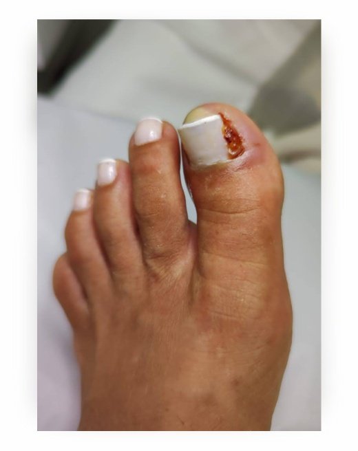 Unha encravada antes do tratamento podológico