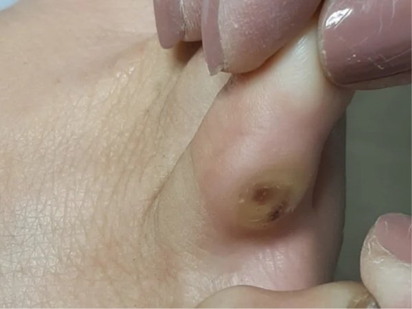 Exemplo de calos e calosidades nos pés antes do tratamento podológico em Vila Velha ES