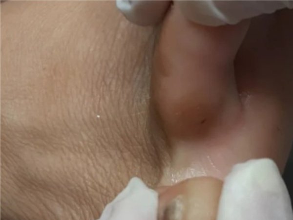 Tratamento profissional para remoção de calos com instrumentos esterilizados no Instituto Rita Dallorto Vila Velha ES